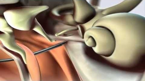 Stapes Animation Using CO2 Laser Fiber