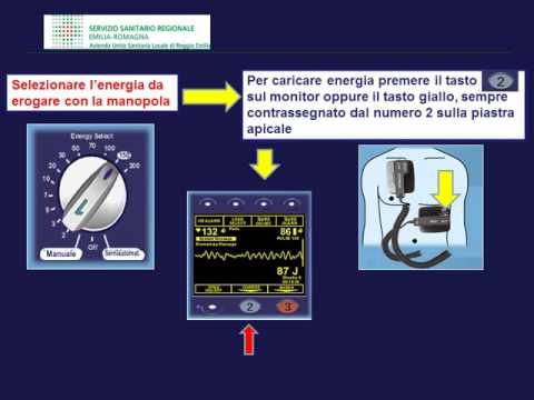 Video: Come identificare il defibrillatore monofasico e bifasico?