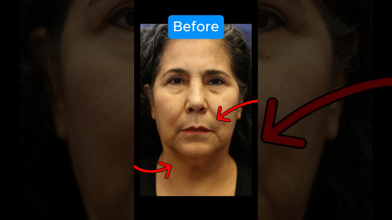 DRAMATIC 1 Year Facelift Transformation (BEFORE AFTER) 
