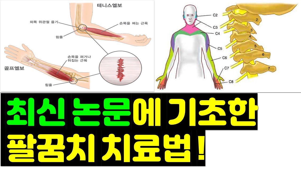 테니스엘보 골프엘보 삼두건염 등 팔꿈치 통증 마지막 해법: 과학이 말하는 엘보우 치료 운동