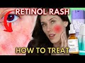 Do You Have A Retinol Rash Or Are You Experiencing Retinization?