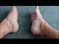 Watch Skin being peeled off of Feet after treatment