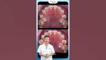 Điều Gì Xảy Ra Khi Niềng Răng Khấp Khểnh | Bác Sĩ Yên
