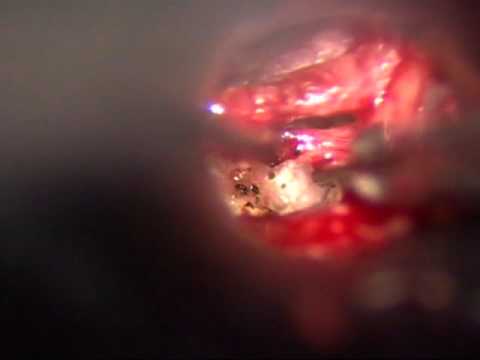 Revision Stapedectomy with Adhesions Using the OmniGuide CO2 Laser Fiber System
