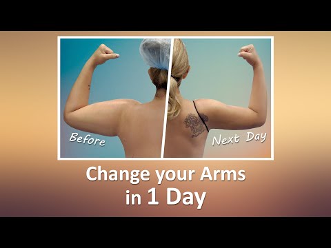 Celebrity Arms™ | Lipo 360° Arms | Immediate Results | High Definition | Expert Dr. Thomas Su