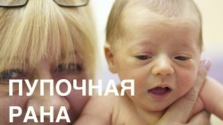 Обработка пупочной раны || ОВП