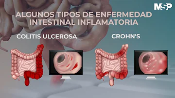 ¿Cómo se curan los intestinos?