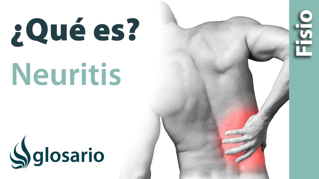 NEURITIS Qué es, qué afecta, síntomas, signos clínicos, causas y tratamiento fisioterapéutico NEURITIS Qué es, qué afecta, síntomas, signos clínicos, causas y tratamiento fisioterapéutico