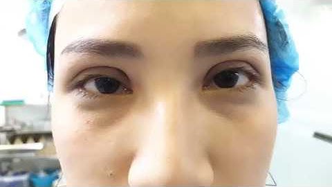 Cắt Mí Sụp Lâu Năm Bằng Công Nghệ Mani Mini Deep 5D.