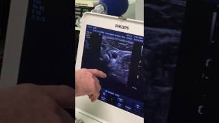 Longus colli function and chin tucks