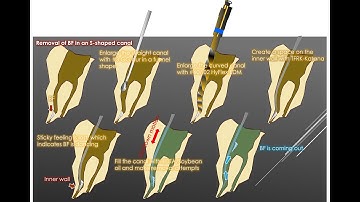 Broken file removal from a double-curvature canal/S字根管の破折器具除去