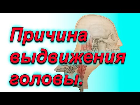 Выдвижение головы вперед. Причины.