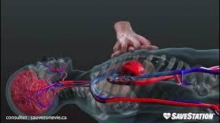FRENCH: La RCR en action | Un aperçu en 3D de l'intérieur du corps