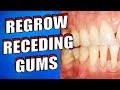 What Causes RECEDING GUMS | How to Reverse RECEDING GUMS Naturally