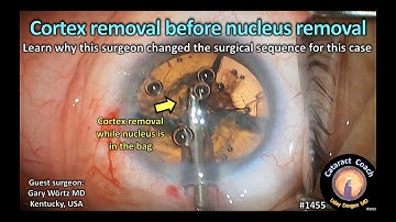 CataractCoach 1455: cortex removal before nucleus removal