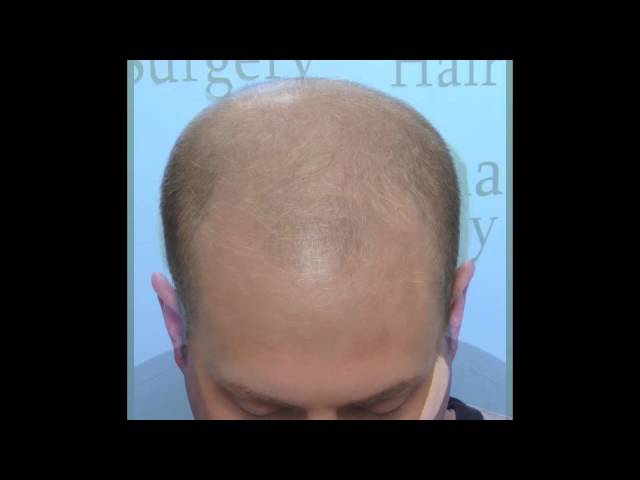 Amazing Hair Transplant Results in 4 Months | Charlotte, NC Hair Surgeon Dr. Vories