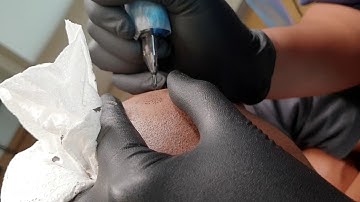 Scalp Micropigmentation Treatment - Scalp Culture