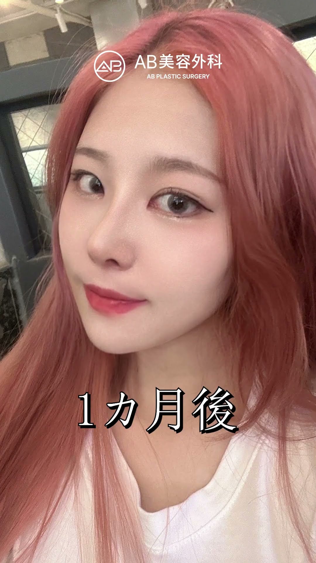 韓国整形フルコースのビフォーアフター #shorts