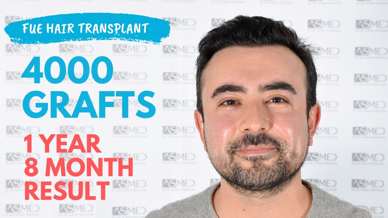 Manual FUE Hair Transplant Before & After, 4000 Grafts 1-Year 8-Month Result-ASMED-Dr. Koray Erdogan