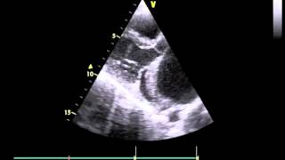 An Ascending Aortic Rent With A Saccular Aneurysm - Video 1