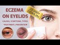 Eczema on Eyelids 2021 | Causes, Symptoms, Types, Treatment and Prevention