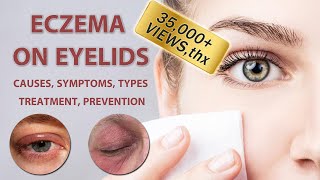 Eczema on Eyelids 2022 - 2023 | Causes, Symptoms, Types, Treatment and Prevention