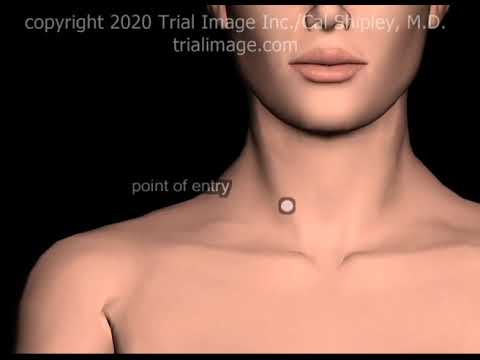 Internal Jugular Vein (IJV) Access Normovolemic Patient Animation by Cal Shipley, M.D.