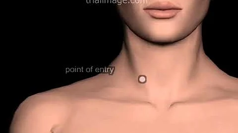 Internal Jugular Vein (IJV) Access Normovolemic Patient Animation by Cal Shipley, M.D.