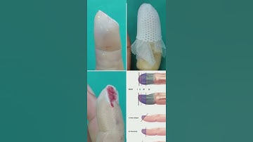 Splint Cap dressing for finger tip injuries