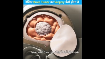 दिमाग मे हुए Tumor का ऑपरेशन कैसे होता है। Brain Tumor 3d animation video, #shorts #mdfactstv