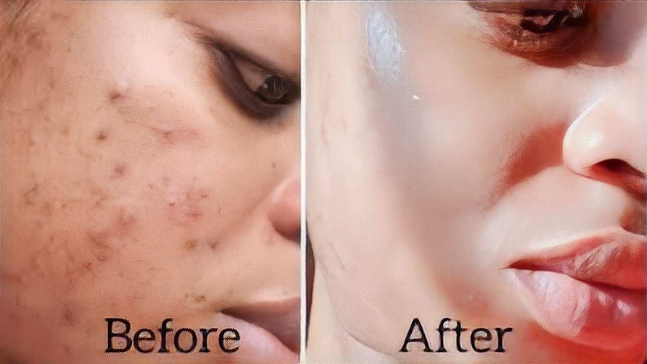 Remove pimple in 7 days permanently |Acne treatment at home