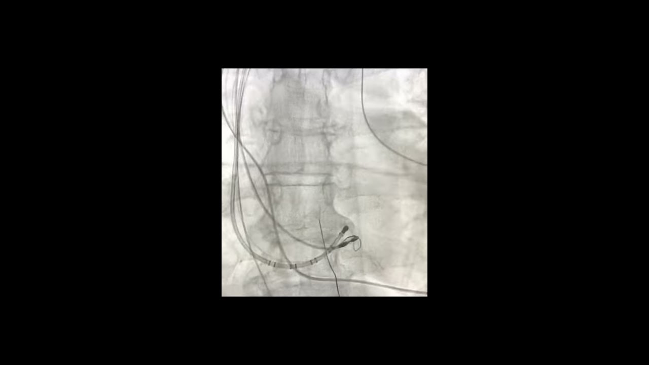  His Pacing New Technique By Felix Yang Pacemaker Physiological