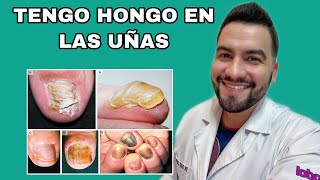 Tengo Hongos En Las Uñas Onicomicosis Tiña Ungueal Dr David Campos