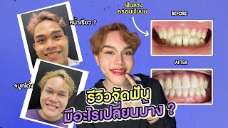 จัดฟัน 3 ปี มีอะไรเปลี่ยนไปบ้าง ?