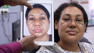 1 week Transformation in Rhinoplasty Surgery in India | Before and After Results