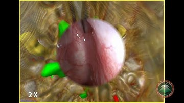 Registration and Fusion Quantification of AR based Nasal Endoscopic Surgery - Case Surgery