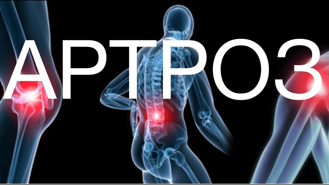 Артроз. Как лечат в Германии.