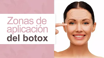 ¿Dónde no debe ponerse bótox en la cara?