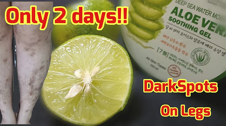 Only 2 days!! How To Remove DarkSpots On Legs, Mosquito Bites, Scar, Hyperpigmentation On Legs Fast