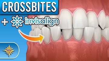 Can Invisalign Fix Crossbites?