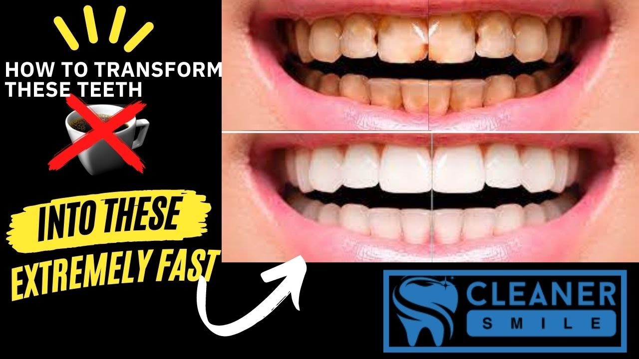 Cleaner Smile Teeth Whitening