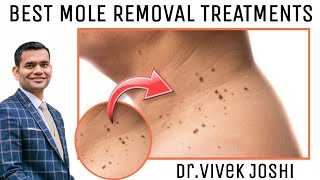 Effective Ways To Remove Moles Naturally | Every Thing about Removing Moles