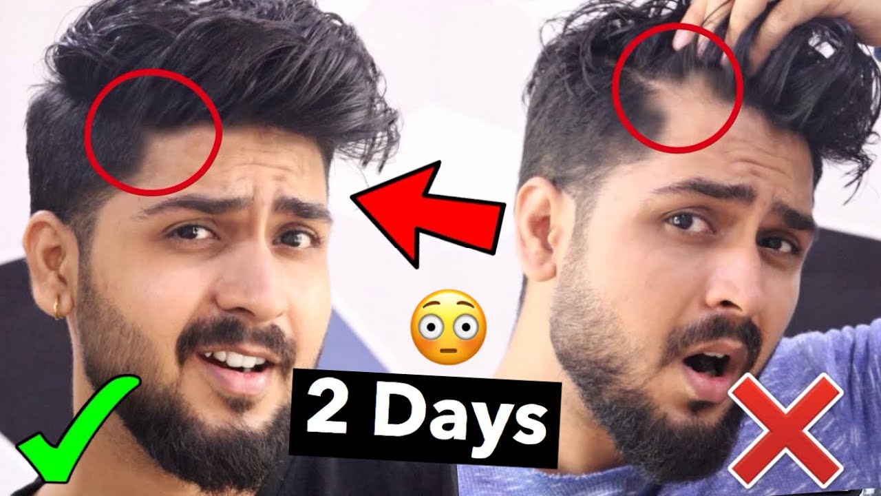 Stop Receding Hairline Hair Fall Naturally Regrow Hair Hair 