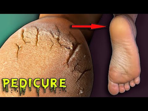 👣ПЕДИКЮР Пошагово. ТРЕЩИНЫ НА ПЯТКАХ. педикюр ДОМА. DIY Pedicure at Home. Extremely Calloused Feet