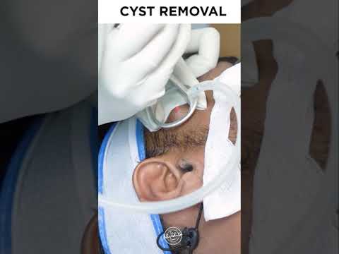 Video: Pes Sebaceous Cysty Home Opravné prostriedky