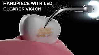 Tips of D600 Ultrasonic Endodontic Expert Introduction