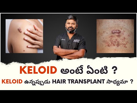 #DrJohnWatts | If You Have Keloids Tendency, Can You Undertake a Hair Transplant? | Explained