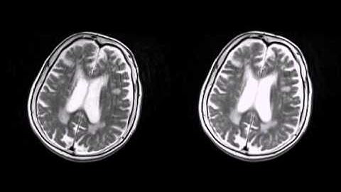 Demonstration of MRI motion correction