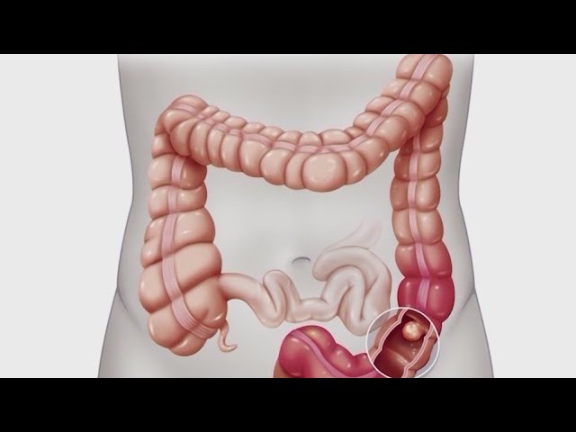 Colon Cancer Awareness Doctors Suggest Colonoscopy