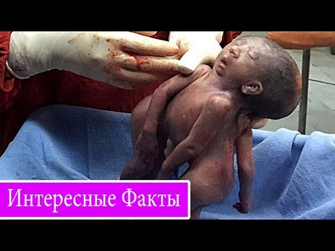 В Индии родились близнецы с одним лицом на двоих - интересные факты